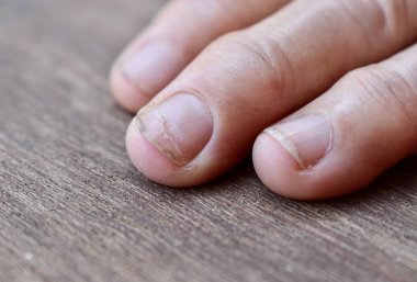 Brittle and damaged fingernails of Asian elder woman. Fungal nail infection.
