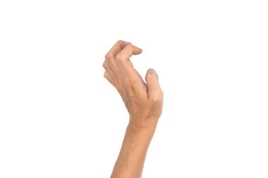 Volkmann contracture in left upper limb of Southeast Asian young man. It is a permanent shortening of forearm muscles that gives rise to a clawlike posture of the hand, fingers, and wrist.