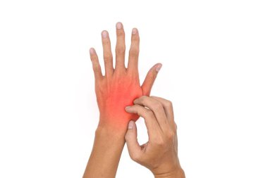 Asian young man scratching his hand. Concept of itchy skin diseases such as scabies, fungal infection, eczema, psoriasis, allergy, etc.