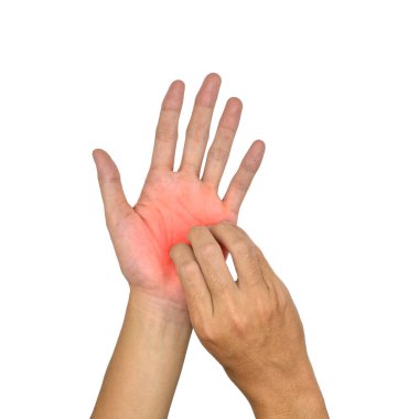 Asian young man scratching his hand. Concept of itchy skin diseases such as scabies, fungal infection, eczema, psoriasis, allergy, etc.