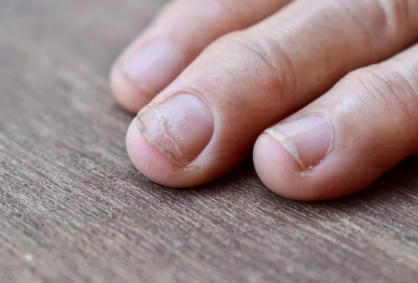 Brittle and damaged fingernails of Asian elder woman. Fungal nail infection.