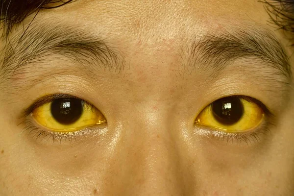 Deep Jaundice Asian Male Patient Yellowish Discoloration Skin Sclera Hyperbilirubinemia — Stock Photo, Image