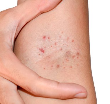 Multiple red spots in cubital fossa showing that Hess test positive. Dengue hemorrhagic fever.