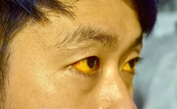 Deep Jaundice Asian Male Patient Yellowish Discoloration Skin Sclera Hyperbilirubinemia — Fotografia de Stock
