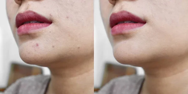 Acne, black spots and scars on face of Asian young woman. Before and after treatment
