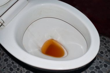 Tuvalette yüksek renkli idrar. Hepatit, leptospirosis, hemolitik hastalıklar ve bazı ilaçlarda yüksek renkli idrara rastlanır..