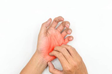 Asian young man scratching his hand. Concept of itchy skin diseases such as scabies, fungal infection, eczema, psoriasis, allergy, etc.