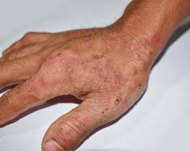 Asyalı yetişkin bir adamın elinde kaşındıran deri lezyonları. Uyuz istilası ya da mantar enfeksiyonu olabilir..