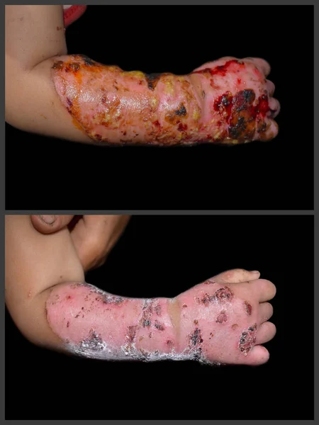 Voor Behandeling Van Brandwond Hand Onderarm Van Zuidoost Aziatische Baby — Stockfoto