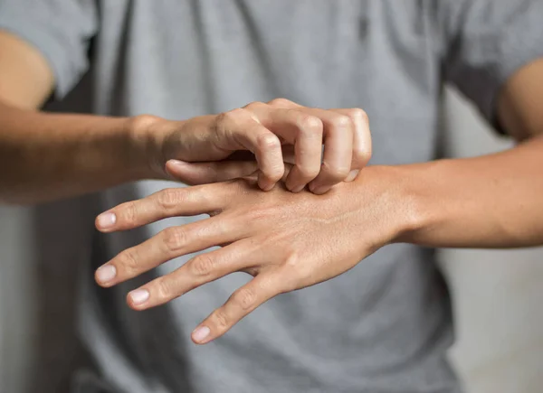 Asiatischer Junger Mann Kratzt Sich Der Hand Konzept Juckender Hauterkrankungen — Stockfoto