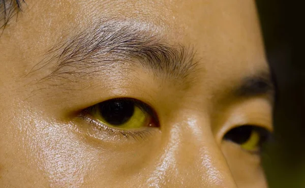 Penyakit Kuning Dalam Pada Pasien Pria Asia Warnanya Kekuningan Pada — Stok Foto