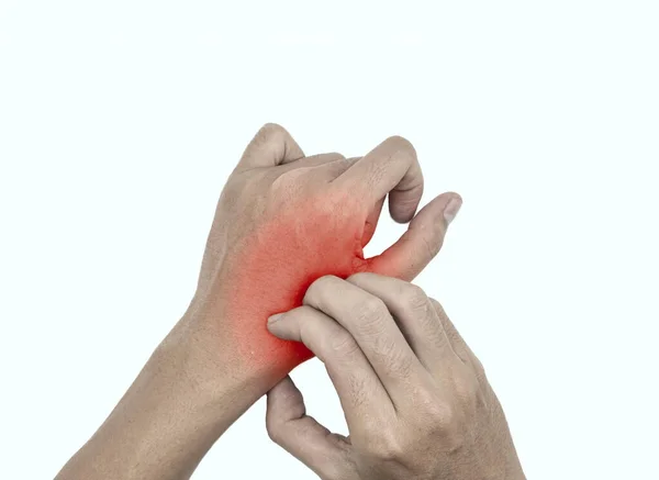 Asian Young Man Scratching His Hand Concept Itchy Skin Diseases — Stock Photo, Image