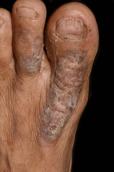 Eczema or fungal infection in foot of Asian man. Closeup view.