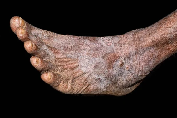 Dry, cracked and scaly skin in foot of Asian, Burmese man. Dermatitis foot.