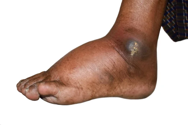 Lochfraßödem Der Unteren Extremität Geschwollenes Bein Eines Asiatischen Alten Mannes — Stockfoto
