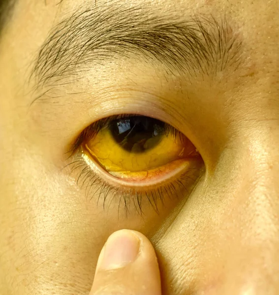 Deep Jaundice Eye Asian Male Patient Yellowish Discoloration Skin Sclera — Stock Photo, Image