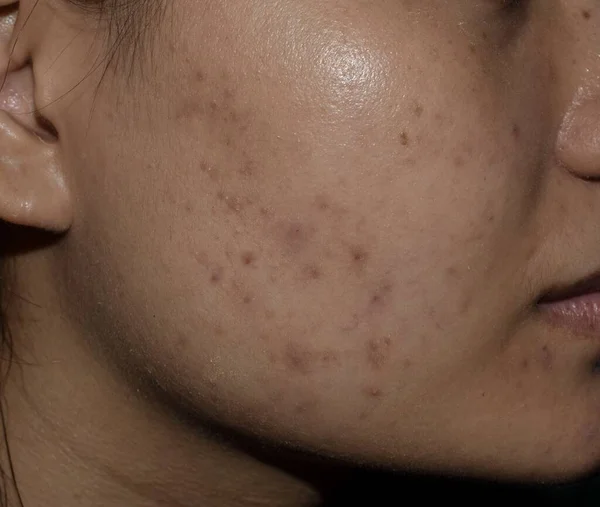 Acne, black spots and scars on face of Asian young woman.