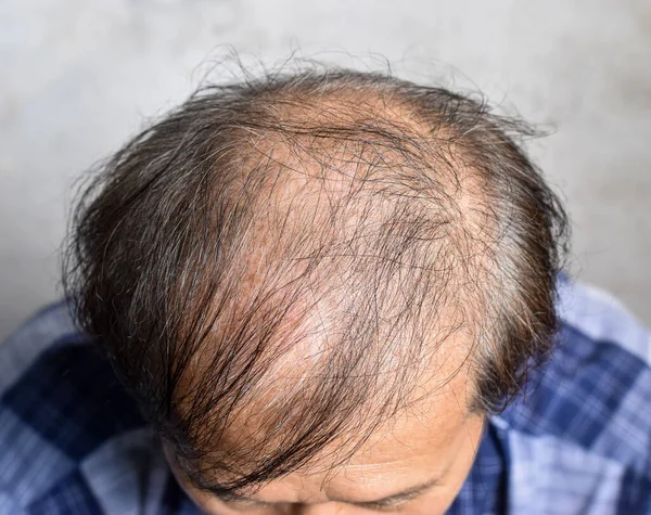 Gallring Eller Glest Hår Manligt Håravfall Sydostasien Kinesisk Äldre Man — Stockfoto
