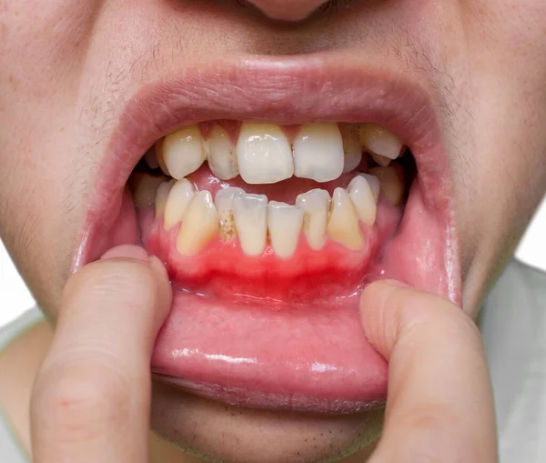 Inflammation Gum Called Gingivitis Periodontal Problem Poor Oral Hygiene — Stock Photo, Image