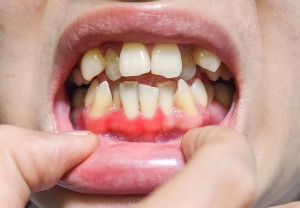Inflamación Encía Llamada Gingivitis Problema Periodontal Mala Higiene Bucal — Foto de Stock