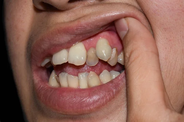 亚洲年轻人的犬牙堆积或重叠 也叫拥挤的牙齿 — 图库照片