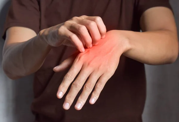 Asian Young Man Scratching His Hand Concept Itchy Skin Diseases — Stock Photo, Image