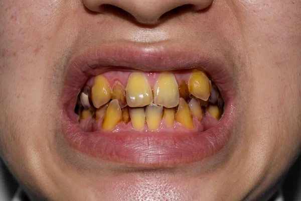 Dientes Abarrotados Con Manchas Tabaco Color Amarillo Mala Higiene Bucal — Foto de Stock