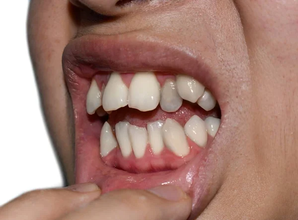 Στοίβες Επικαλυπτόμενα Λευκά Δόντια Ασιάτη Ονομάζεται Επίσης Γεμάτο Δόντια — Φωτογραφία Αρχείου