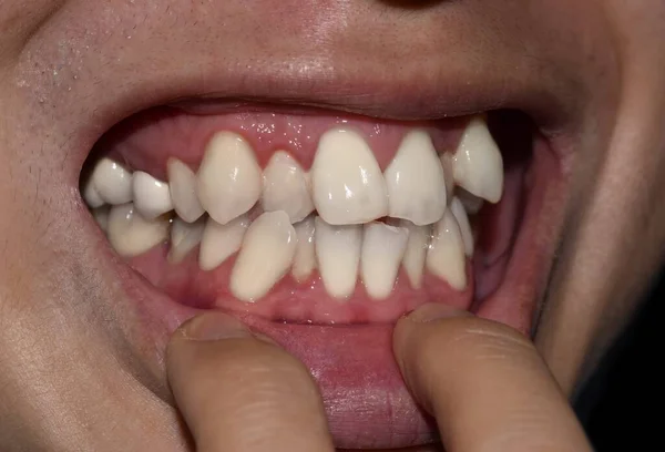 Apilados Superpuestos Dientes Blancos Hombre Asiático También Llama Dientes Apiñados —  Fotos de Stock