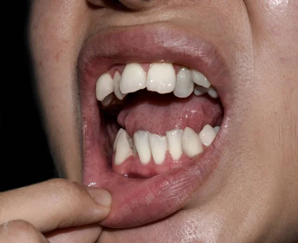 Apilados Superpuestos Dientes Blancos Hombre Asiático También Llama Dientes Apiñados — Foto de Stock