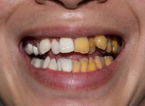 Comparison of before and after scaling and polishing treatment for tobacco stains on crowded teeth of Asian young man. Resulting in white and brighten teeth.