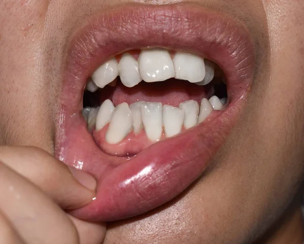 Apilados Superpuestos Dientes Blancos Hombre Asiático También Llama Dientes Apiñados —  Fotos de Stock