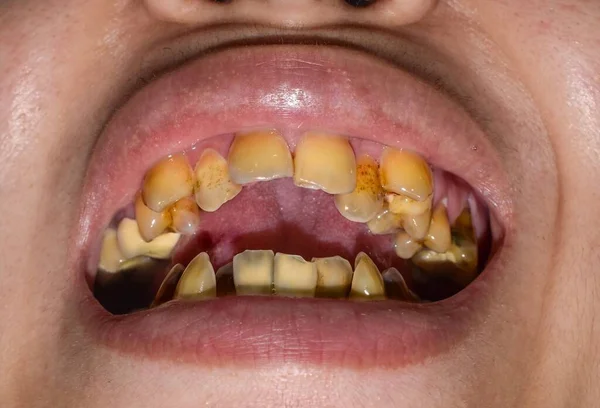 Crowded teeth with yellow colored tobacco stains. Poor oral hygiene.