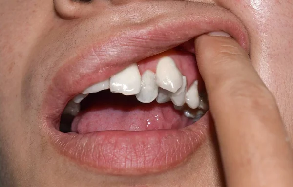 亚洲人白牙的堆积或重叠 也叫拥挤的牙齿 — 图库照片
