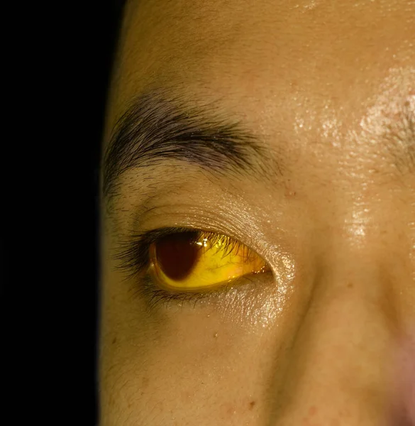 アジア系男性患者の深い黄疸 皮膚や皮膚の黄色がかった変色 高ビリルビン血症 急性肝炎 — ストック写真