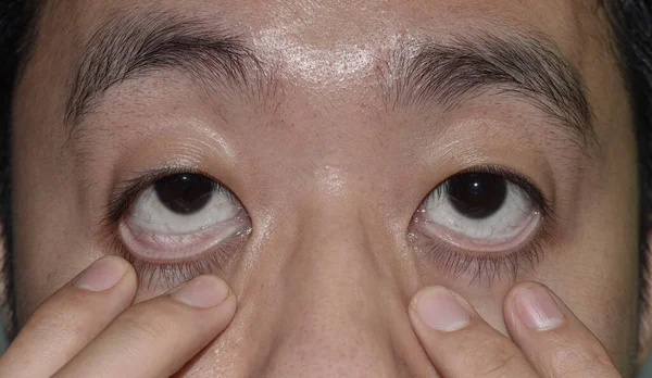 Pale Skin Asian Young Man Sign Anemia Pallor Eyelid — Stock Photo, Image