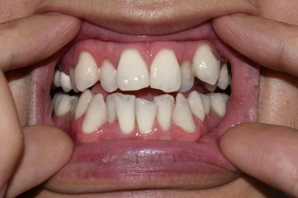 Apilados Superpuestos Dientes Blancos Hombre Asiático También Llama Dientes Apiñados — Foto de Stock