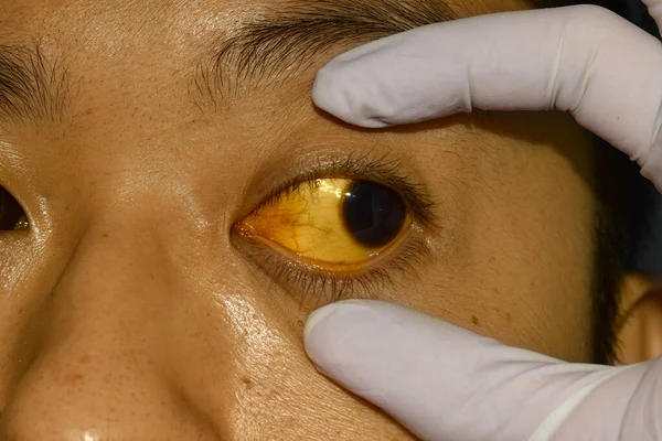 Deep Jaundice Asian Male Patient Yellowish Discoloration Skin Sclera Hyperbilirubinemia — Stock Photo, Image