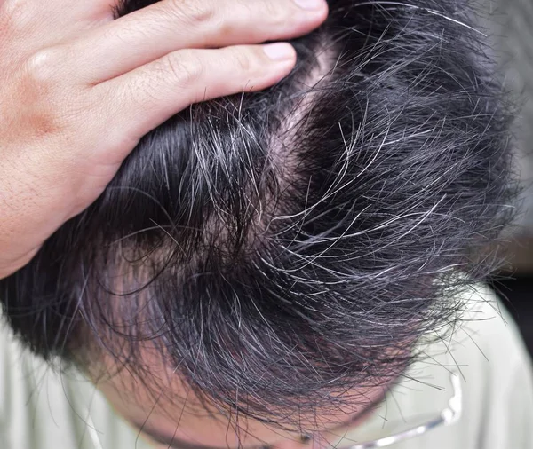 Передчасне Вибілювання Волосся Раннє Старіння Сірий Колір Волосся Азіатському Юнаку — стокове фото