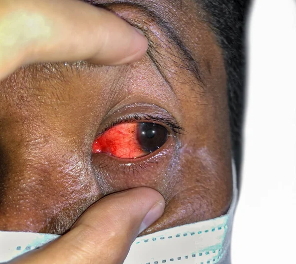 Corneal Infection Ulcer Called Keratitis Asian Old Woman — Stok Foto