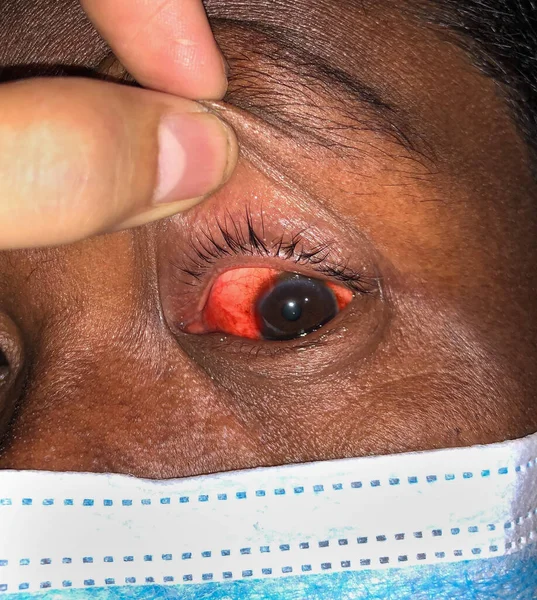 Corneal Infection Ulcer Called Keratitis Asian Old Woman — Stok Foto