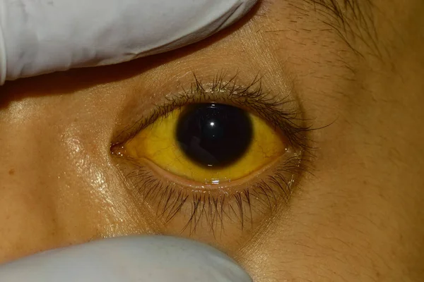 Penyakit Kuning Dalam Pada Pasien Pria Asia Warnanya Kekuningan Pada — Stok Foto