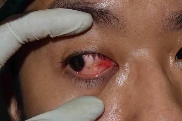 Infeksi Kornea Atau Ulkus Disebut Keratitis Pada Pemuda Asia — Stok Foto