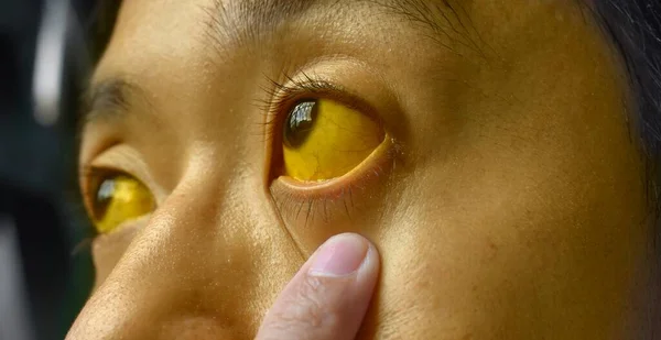 Deep Jaundice Asian Male Patient Yellowish Discoloration Skin Sclera Hyperbilirubinemia — Stock Photo, Image