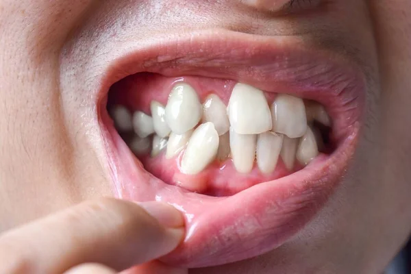 アジア人の白い歯を積み重ねたり重ねたり 混雑歯とも呼ばれる — ストック写真