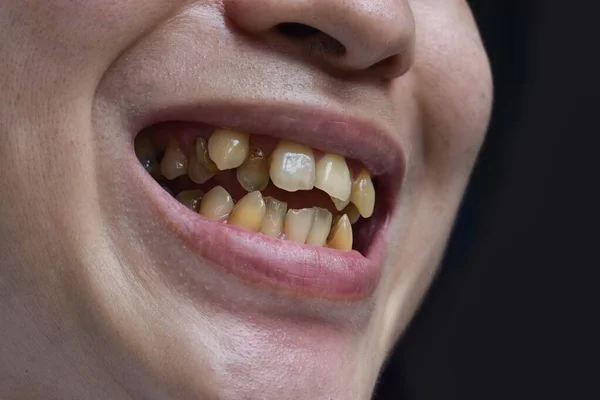 Denti Affollati Con Macchie Tabacco Colore Giallo Scarsa Igiene Orale — Foto Stock