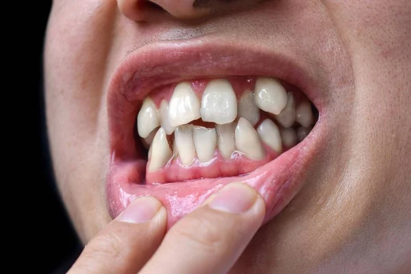 아시아 이빨이 벗겨지거나 겹쳐지고 이빨이라고 불리기도 합니다 — 스톡 사진