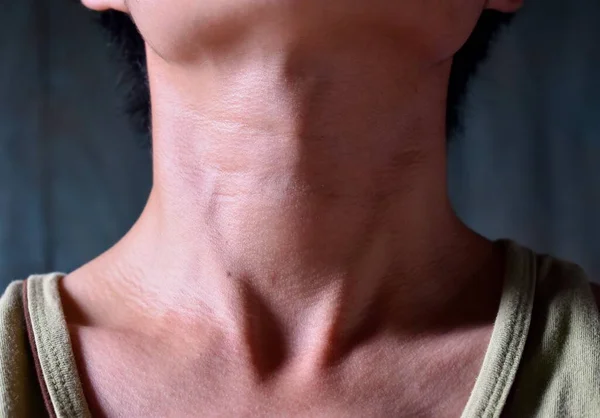 Halsschwellungen Diagnostiziert Als Schilddrüsenüberfunktion Alternde Hautfalten Oder Hautfalten Oder Falten — Stockfoto