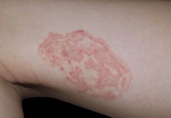 Fungal infection called tinea corporis in thigh of Southeast Asian child. Ringworm