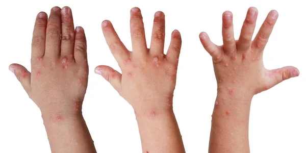 Wysypka Pęcherzowa Rękach Hfmd Wyizolowana Białym Enterowirusie Tła Wirus Coxsackie — Zdjęcie stockowe